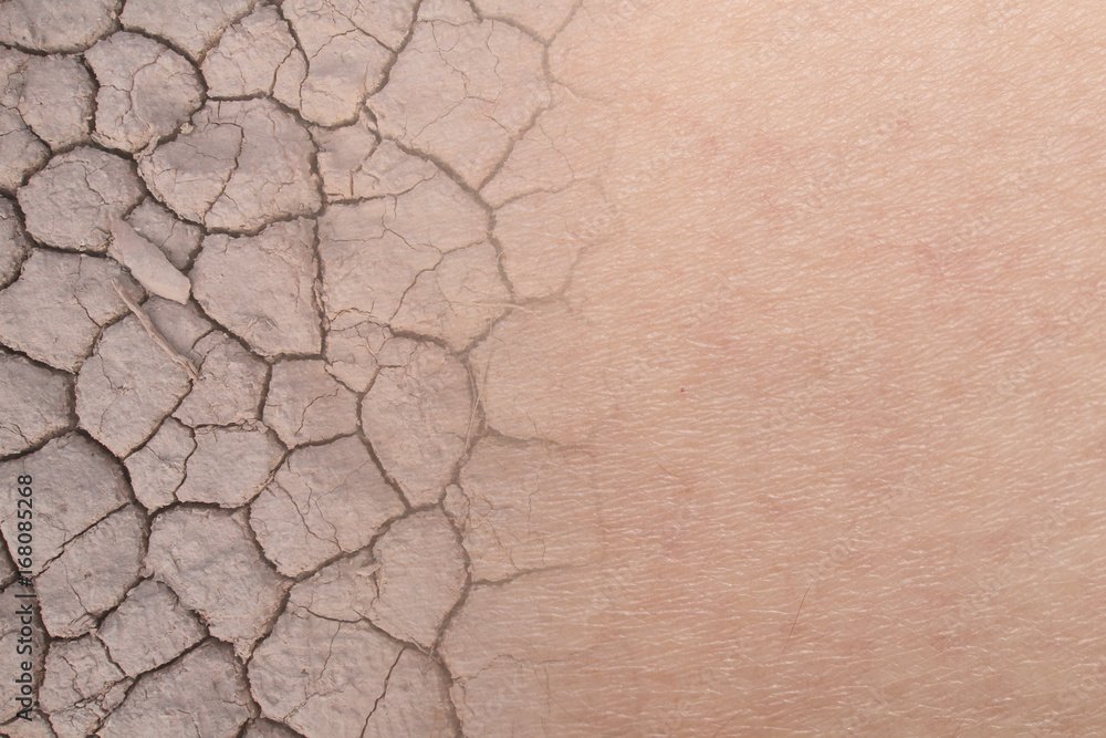Dry Skin