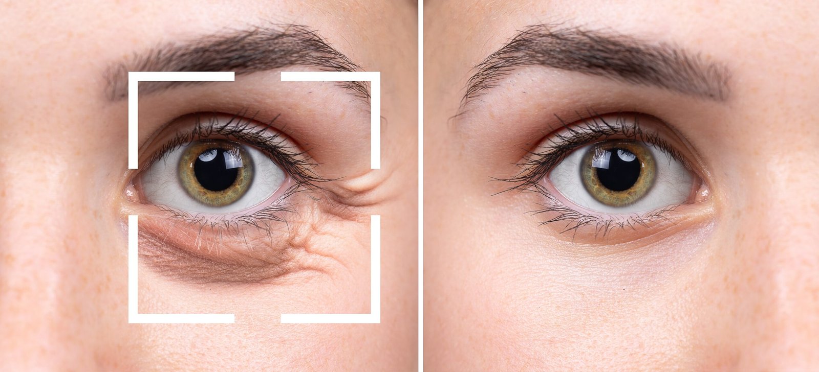 Eye Bag
